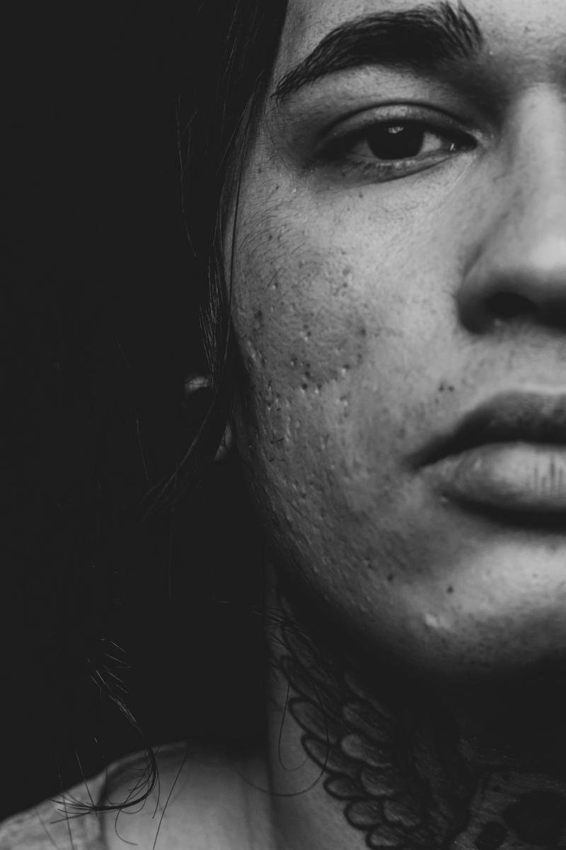 Acne scars