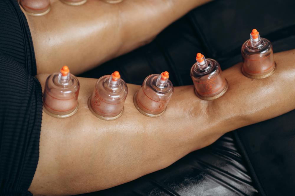 cupping therapy