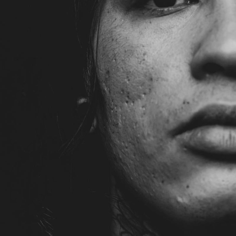 Acne-scars-d896923a2e9846e78912ece693437499